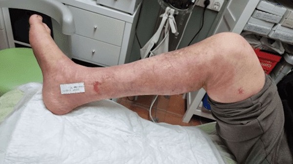 Dermatite de stase : symptômes, causes et traitement