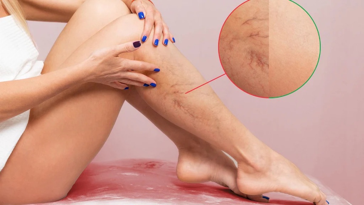 Dermatite de stase : symptômes, causes et traitement