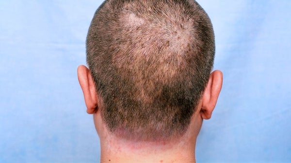 Dermatite séborrhéique ou pellicules ? Comment les distinguer