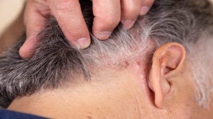 Dermatite séborrhéique ou pellicules ? Comment les distinguer