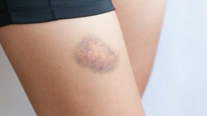 Ecchymoses : pourquoi surviennent-elles et quand faut-il s’inquiéter ?