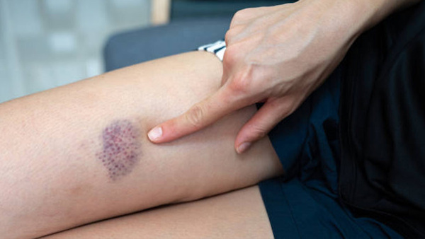 Ecchymoses : pourquoi surviennent-elles et quand faut-il s’inquiéter ?