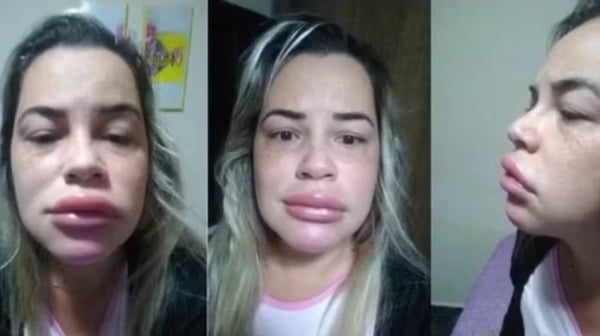 Elle voulait mettre de l'acide hyaluronique dans ses lèvres mais ils lui ont appliqué du PMMA
