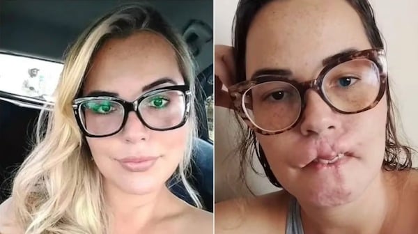 Elle voulait mettre de l'acide hyaluronique dans ses lèvres mais ils lui ont appliqué du PMMA