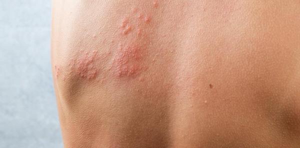 Éruption cutanée due à la chaleur : symptômes, diagnostic et traitement