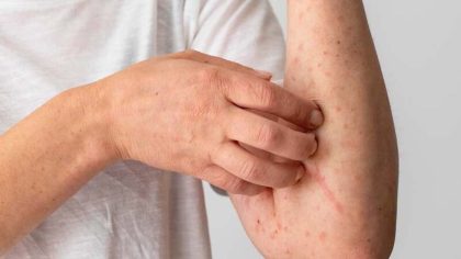 Éruption cutanée due à la chaleur : symptômes, diagnostic et traitement