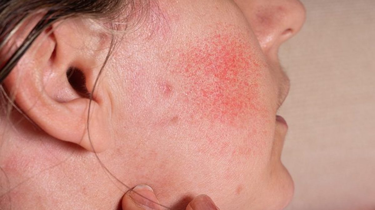 Érythème bulleux multiforme étendu associé à une infection par le virus de l'herpès simplex