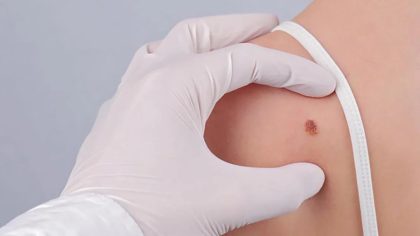 Grains de beauté : types, causes, diagnostic et traitement