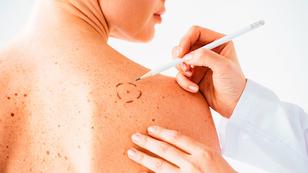 Grains de beauté : types, causes, diagnostic et traitement