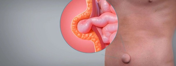 Hernie ombilicale : causes, symptômes, complications et traitement