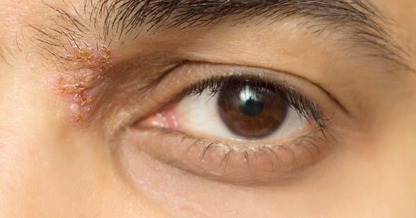 Herpès oculaire : causes, symptômes et traitement