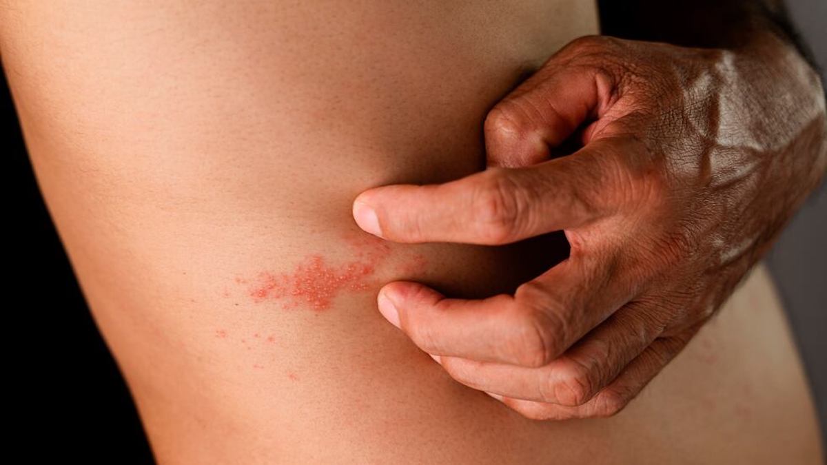 Herpès zoster : qu'est-ce que c'est, symptômes, diagnostic et traitement