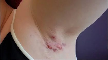 Hidradénite suppurée : symptômes, causes et traitement