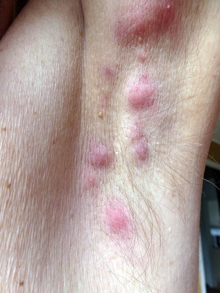 Hidradénite suppurée : symptômes, causes et traitement