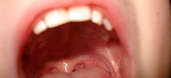 Infections buccales : causes, types et traitements