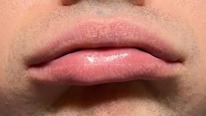 La raison pour laquelle les gens ont d'étranges bosses blanches sur les lèvres