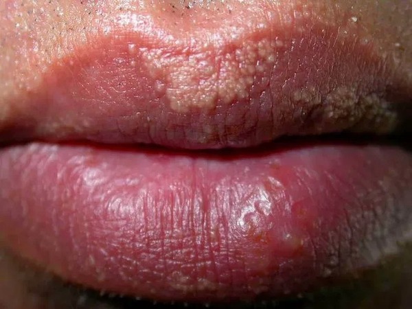 La raison pour laquelle les gens ont d'étranges bosses blanches sur les lèvres