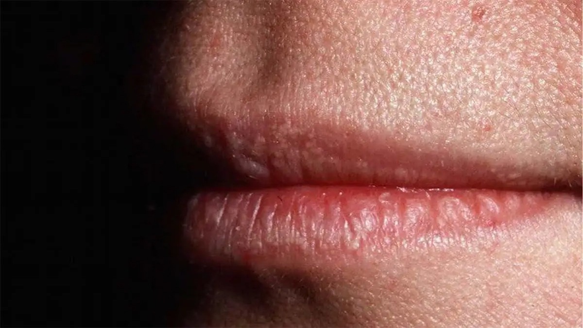 La raison pour laquelle les gens ont d'étranges bosses blanches sur les lèvres