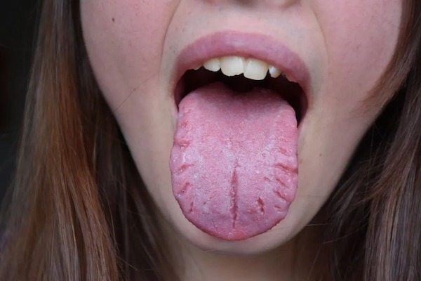 Langue fissurée ou craquelée : causes et traitements