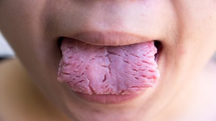 Langue fissurée ou craquelée : causes et traitements