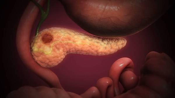 Le symptôme silencieux du cancer du pancréas que personne ne connaît