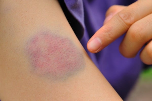 Leucémie : causes, traitement et signes précoces