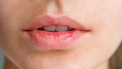 Lèvres sèches et gercées : causes et solutions