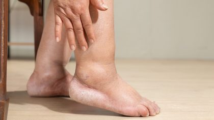 Lymphœdème : symptômes et causes