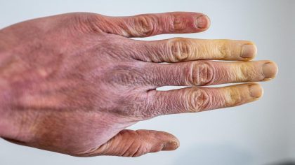 Maladie de Raynaud : symptômes et causes