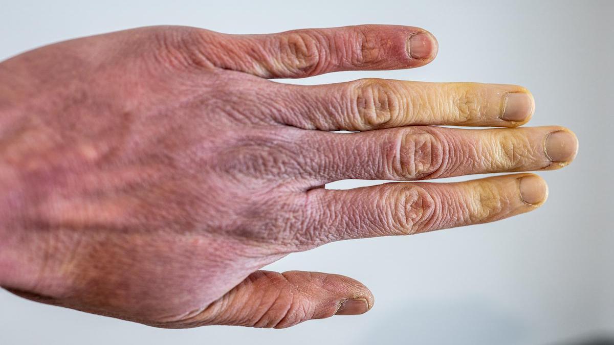 Maladie de Raynaud : symptômes et causes