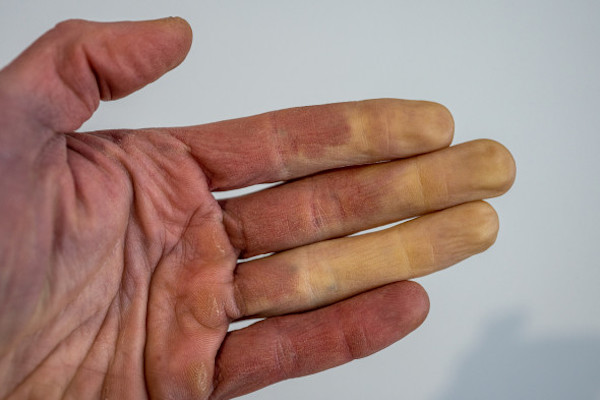 Maladie de Raynaud : symptômes et causes