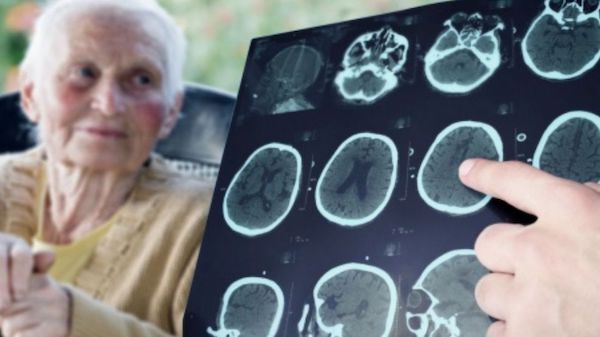 Médicaments qui augmentent le risque de maladie d'Alzheimer