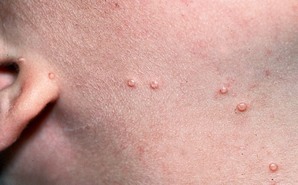 Molluscum contagiosum, une infection cutanée courante qui se propage facilement