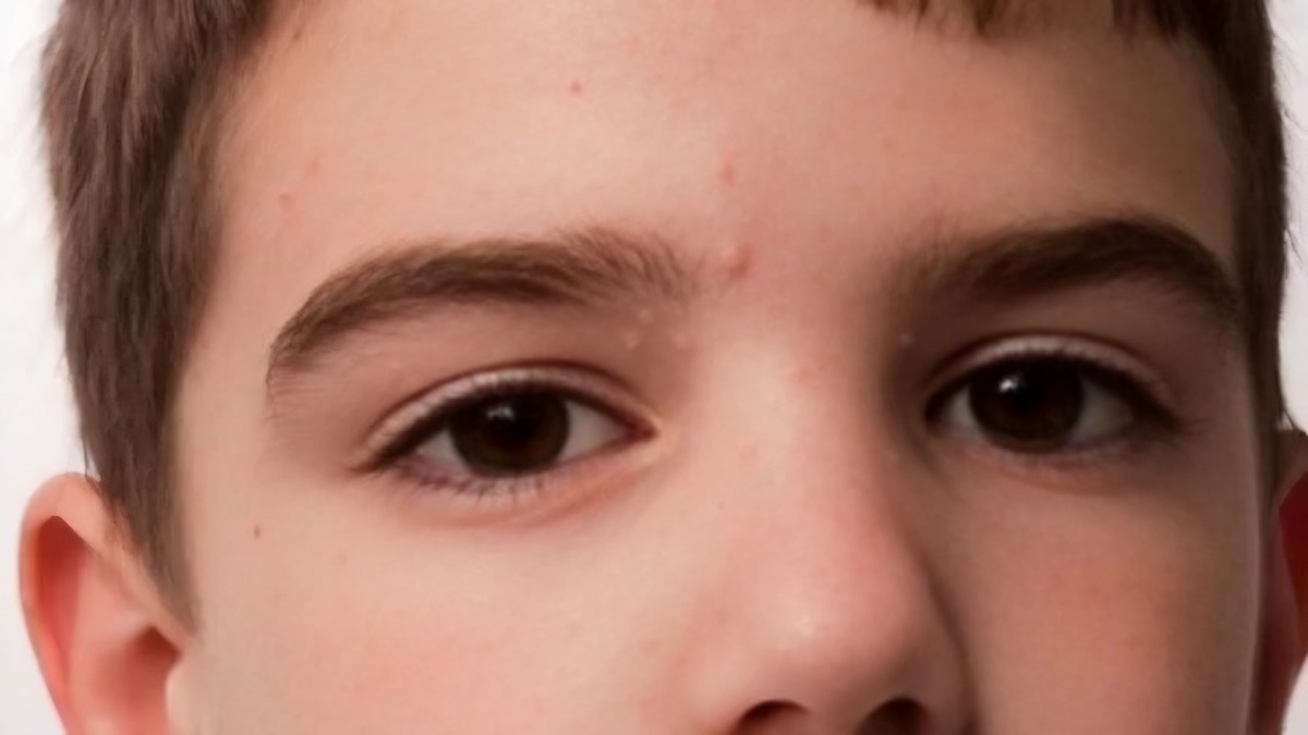Molluscum contagiosum, une infection cutanée courante qui se propage facilement