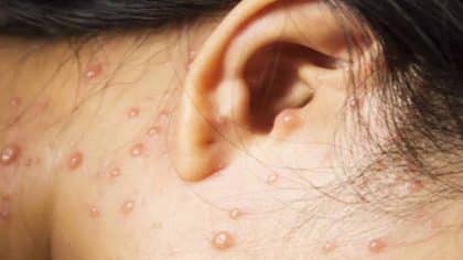 Molluscum contagiosum, une infection cutanée courante qui se propage facilement