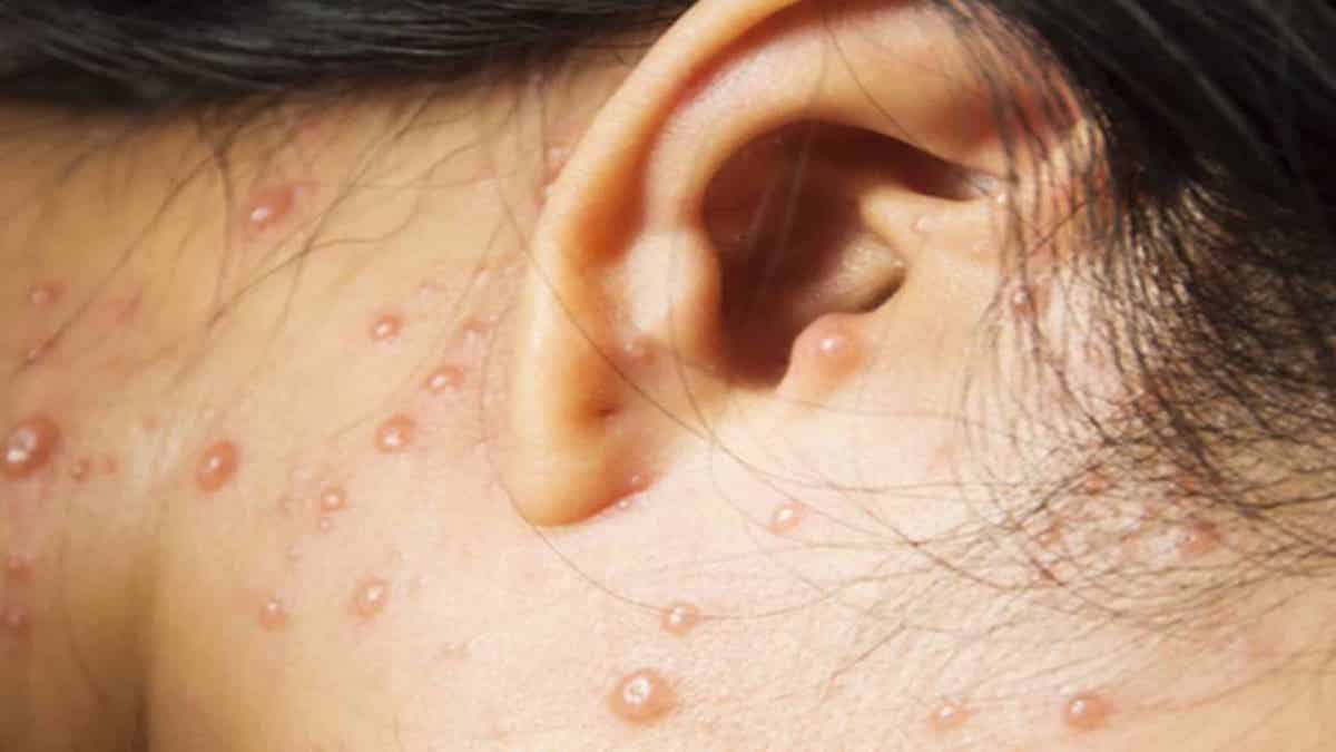 Molluscum contagiosum, une infection cutanée courante qui se propage facilement