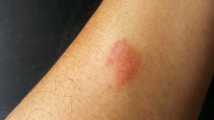 Morsure de mille-pattes : causes, symptômes et traitement