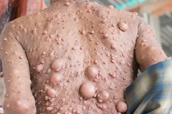 Neurofibromatose : symptômes et causes