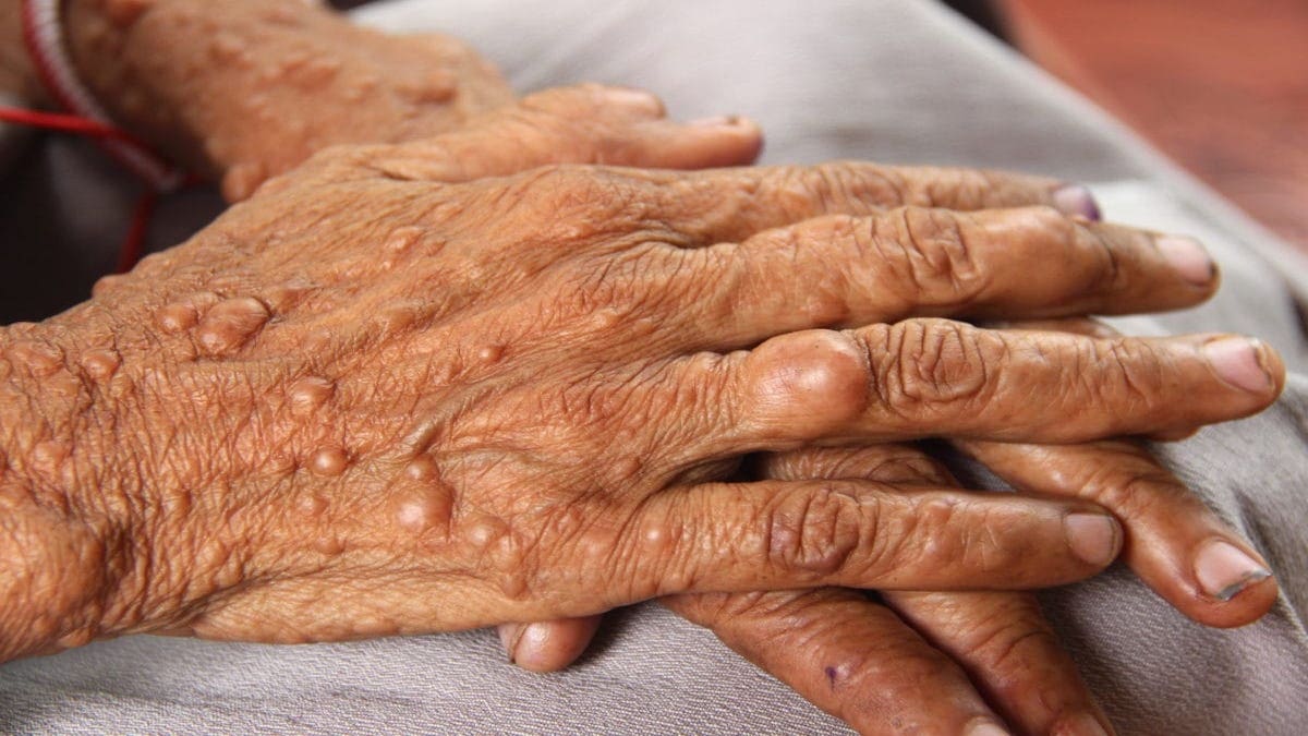Neurofibromatose : symptômes et causes