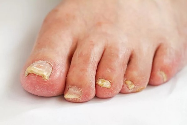 Ongles épais : causes, symptômes et traitements