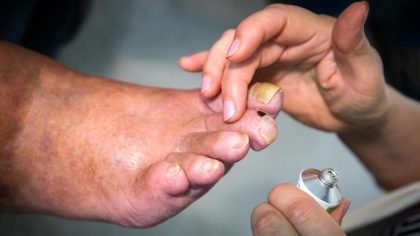 Ongles épais : causes, symptômes et traitements