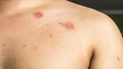 Pityriasis versicolor : symptômes, diagnostic et traitement