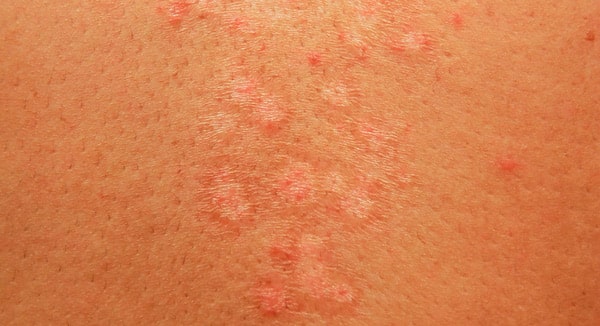 Pityriasis versicolor : symptômes, diagnostic et traitement