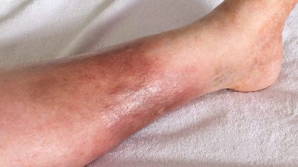 Pourquoi la cellulite infectieuse survient