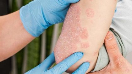 Psoriasis : symptômes, causes et traitements