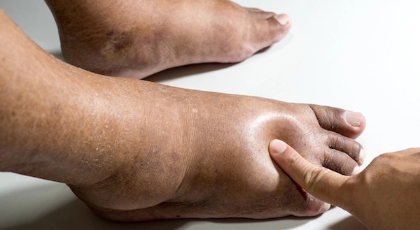 Quelles maladies provoquent un gonflement des pieds ?