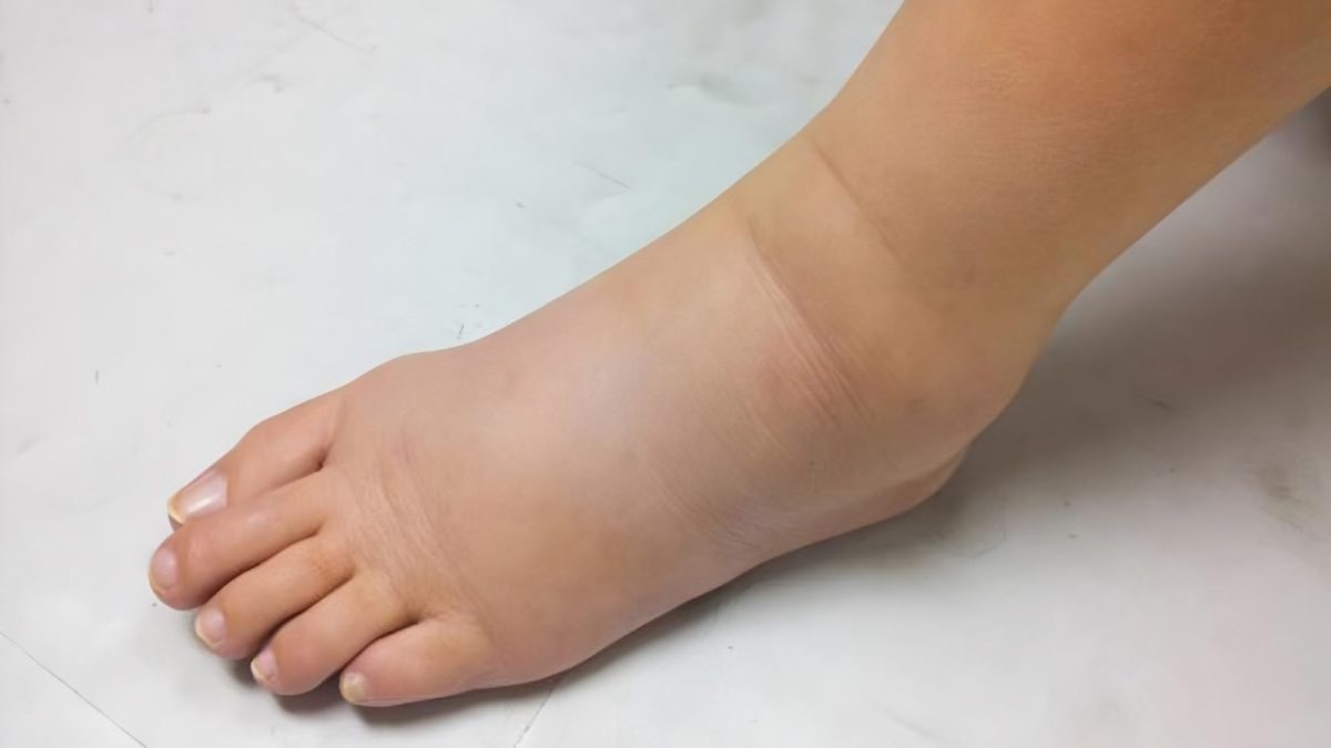 Quelles maladies provoquent un gonflement des pieds ?