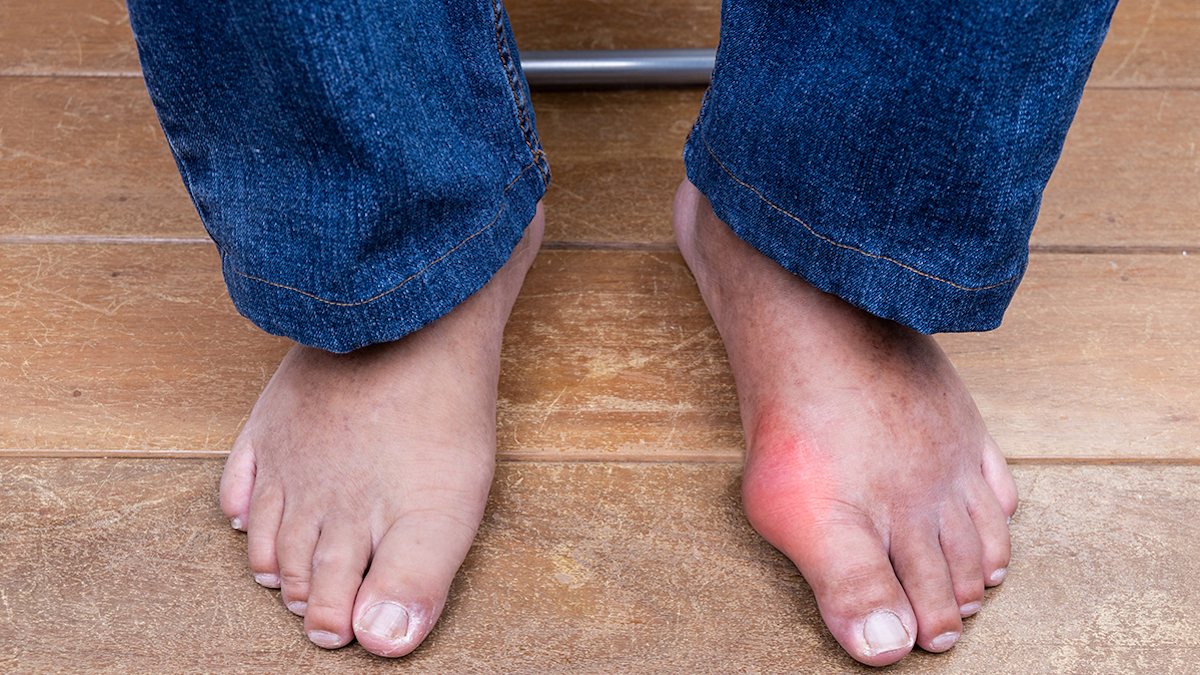 Quelles maladies provoquent un gonflement des pieds ?