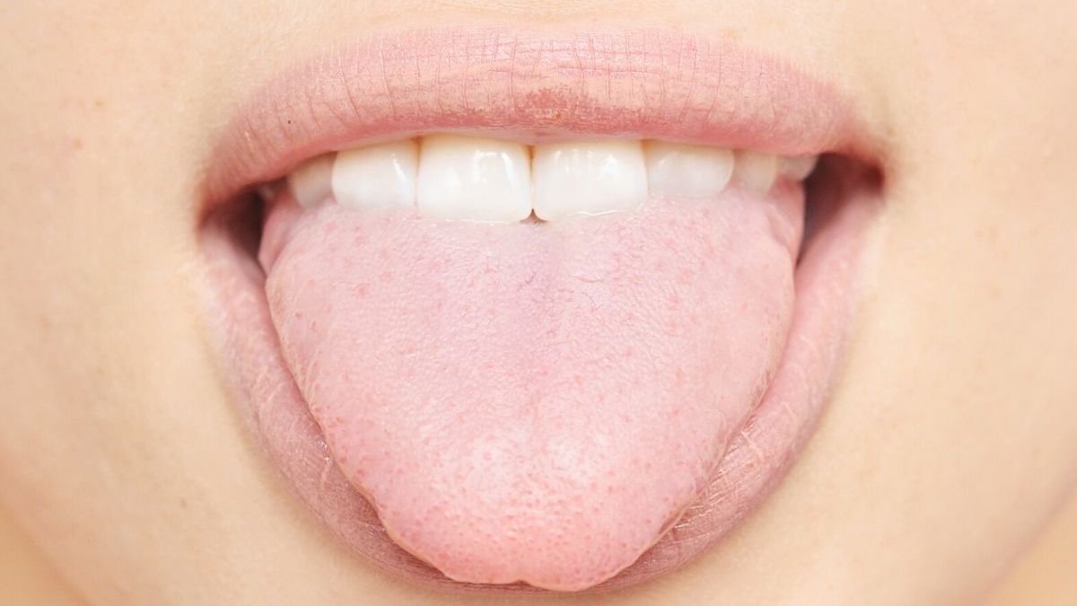 Qu'est-ce que la langue blanche ? Causes et symptômes