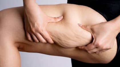 Qu'est-ce que la peau d'orange ? Tout ce que vous devez savoir sur la cellulite